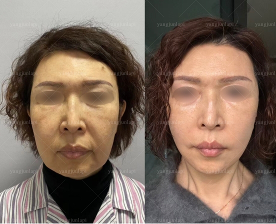 杨俊医生小拉皮为什么口碑好？揭秘自然抗衰的核心秘诀